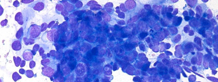 tumori:-cdc-melanomi-negli-usa-raddoppiati-in-30-anni