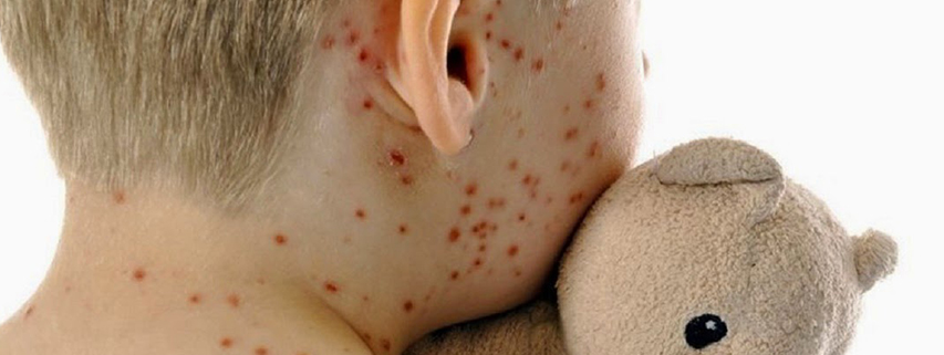 Morbillo,-aumentano-i-casi-dopo-la-flessione-del-2015